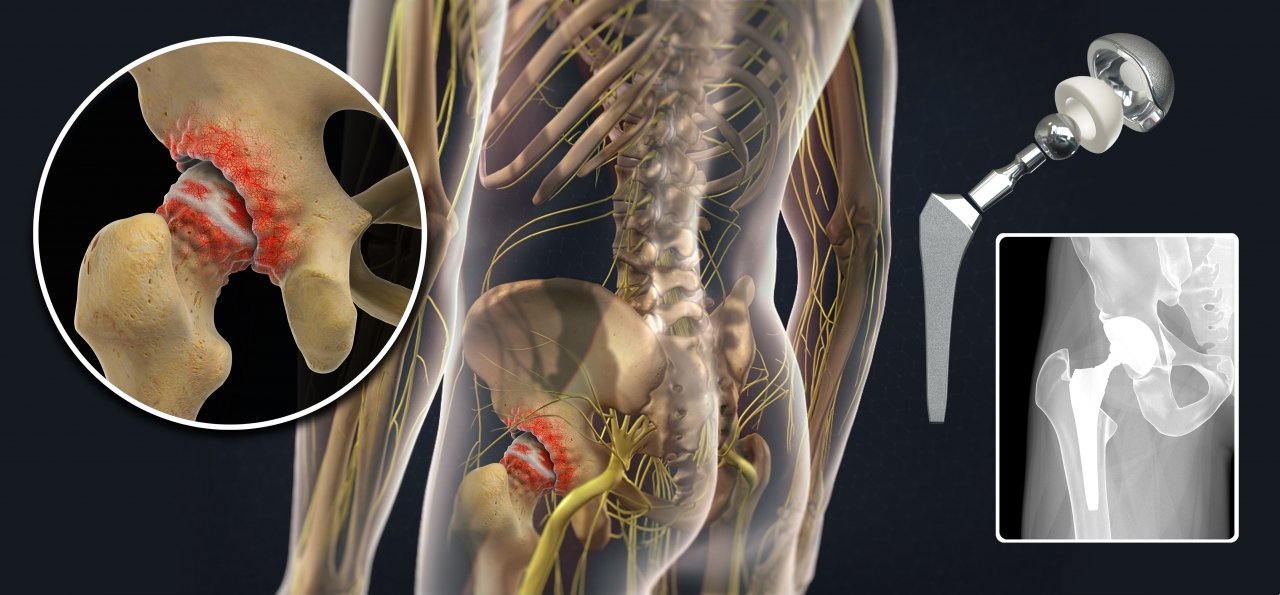 Anterior Approach to Total Hip Replacement Surgery