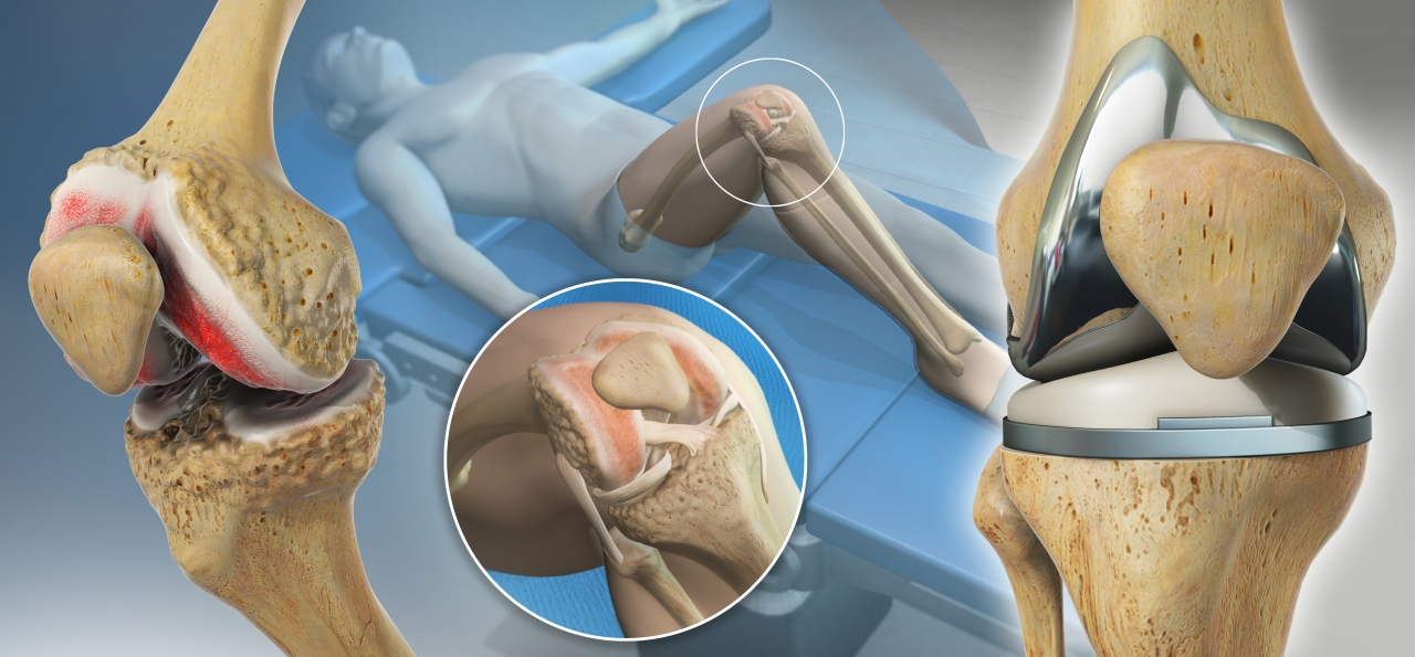 Understanding Computer-Assisted Knee Surgery